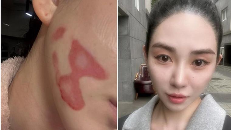 "2도 화상 공황발작&qu