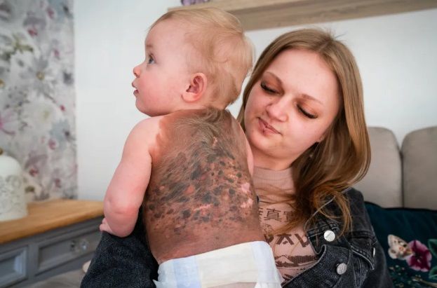 태어날 때부터 검은 반점과 털로 뒤