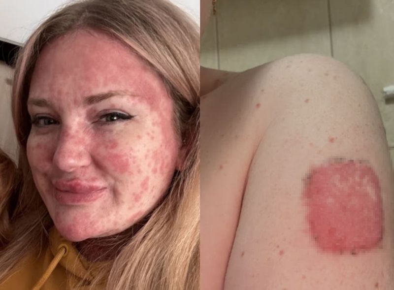 백신 접종 했는데 홍역 걸린 女, 