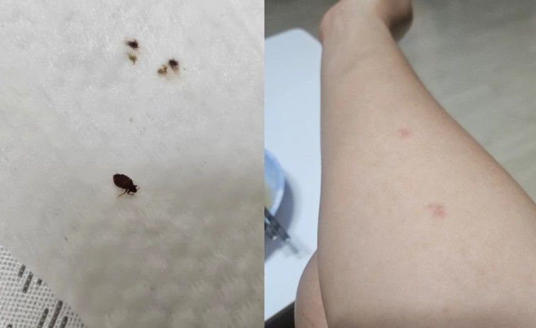 빈대 물렸을 때 절대 긁으면 안 되